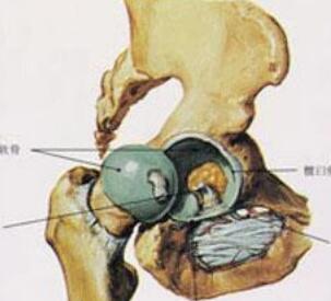 酒精性股骨头坏死